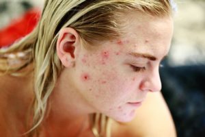 Como eliminar el acné